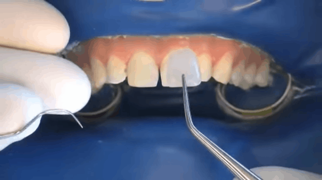 Quy trình dán sứ veneer: Đơn giản và ít phải mài hơn làm răng sứ, nhưng cũng khó nhằn ra phết - Ảnh 6.