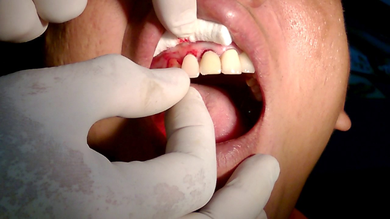 Quy trình dán sứ veneer: Đơn giản và ít phải mài hơn làm răng sứ, nhưng cũng khó nhằn ra phết - Ảnh 5. Quy trình dán sứ veneer: Đơn giản và ít phải mài hơn làm răng sứ, nhưng cũng khó nhằn ra phết - Ảnh 5.