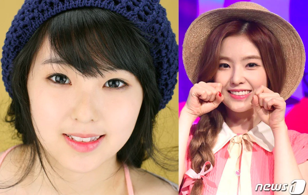 Xem loạt ảnh Before - After n&agrave;y mới thấy c&ocirc;ng nghệ thẩm mỹ răng đ&atilde; gi&uacute;p c&aacute;c idol xứ H&agrave;n l&ecirc;n đời nhan sắc như thế n&agrave;o - Ảnh 13.