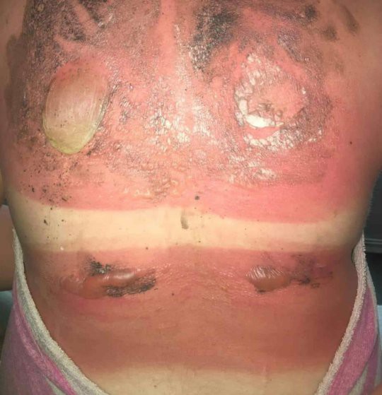Cô gái 16 tuổi bị bỏng nắng nghiêm trọng khiến vùng lưng nổi đầy mụn nước siêu to khổng lồ - Ảnh 4.