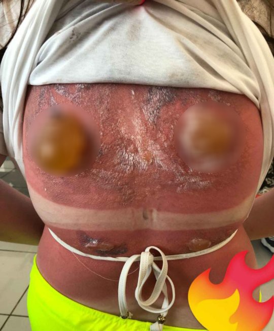 Cô gái 16 tuổi bị bỏng nắng nghiêm trọng khiến vùng lưng nổi đầy mụn nước siêu to khổng lồ - Ảnh 2.