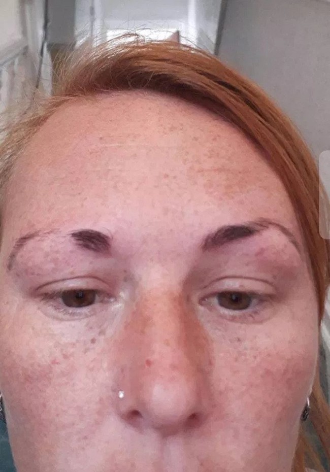 Người phụ nữ kh&oacute;c ra tiếng M&aacute;n v&igrave; l&ocirc;ng m&agrave;y l&aacute; liễu bỗng h&oacute;a s&acirc;u r&oacute;m đen s&igrave; sau khi tới spa - Ảnh 3.