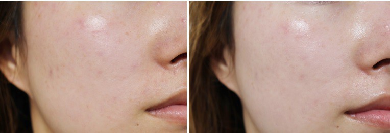 Serum nhầy ốc sên làm đầy sẹo rỗ hot rần rần, nhìn những chứng thực này thì mua hay không mua tùy bạn - Ảnh 8.