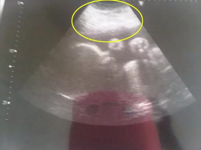 Đang mang thai tháng thứ 9, người phụ nữ phát hiện điều kỳ lạ trong buồng trứng khiến cô mãn kinh ở tuổi 23 - Ảnh 2.