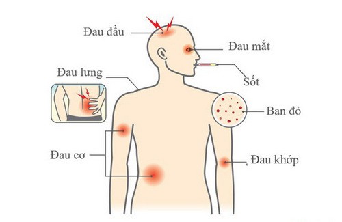 Chăm sóc trẻ sốt xuất huyết thế nào mới đúng? - Ảnh 2.