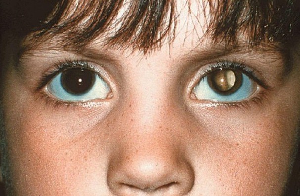 Ngắm hình chụp con gái, mẹ bàng hoàng phát hiện dấu hiệu lạ ở đôi mắt, đi khám mới biết con mắc bệnh ung thư mắt - Ảnh 5.