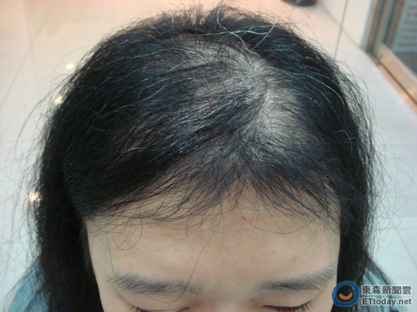Rụng tóc nhiều: Nguyên nhân, Dấu hiệu, phân loại và chẩn đoán
