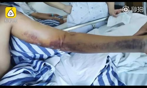 Nam sinh bị g&atilde;y tay đau đớn khi c&ugrave;ng bạn thi đấu tr&ograve; quen thuộc thời đi học nhiều người th&iacute;ch chơi - Ảnh 1.