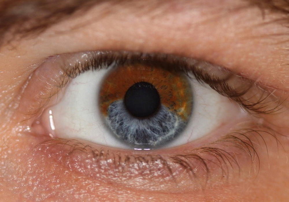 Почему глаза стали голубые. Гетерохромия радужной оболочки. Гетерохромия Фукса катаракта. Колобома радужной оболочки глаза. Гетерохромия и анизокория.