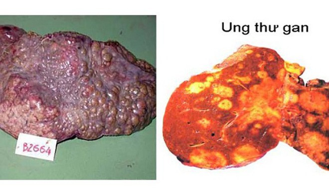 Chuyên gia lý giải vì sao ung thư gan vọt lên vị trí đầu bảng - Ảnh 2.
