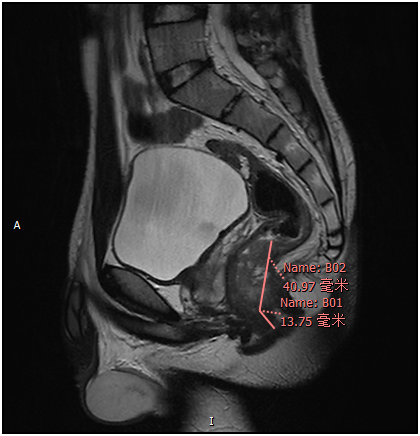 Chàng trai 17 tuổi phát hiện mình bị ung thư trực tràng thông qua những triệu chứng chẳng ai ngờ tới - Ảnh 2.