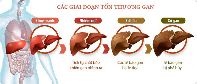 Đường ruột tự sinh ra rượu: Hội chứng kỳ lạ khiến nhiều người ăn cơm cũng say và mắc bệnh gan như người nghiện rượu - Ảnh 2.