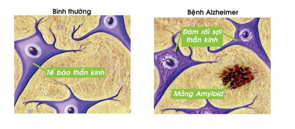  Công bố mới: Đã có vắc-xin đặc trị chứng mất trí Alzheimer  - Ảnh 3.