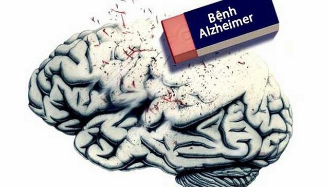  C&ocirc;ng bố mới: Đ&atilde; c&oacute; vắc-xin đặc trị chứng mất tr&iacute; Alzheimer  - Ảnh 4.