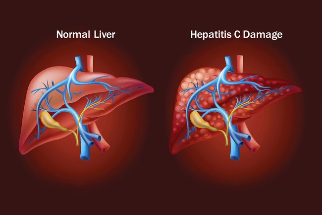 WHO cảnh báo: Việt Nam có gần 1 triệu ca nhiễm virus viêm gan C nên cần chủ động phòng ngừa ngay các con đường dễ lây nhiễm sau - Ảnh 2.