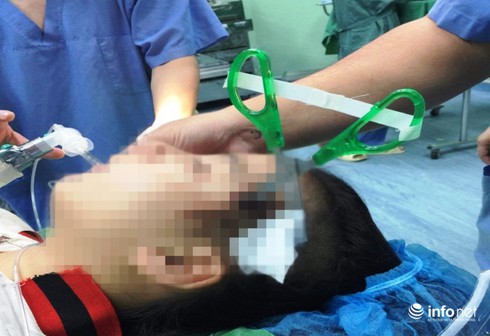 Nghệ An: Bị kéo nhọn găm vào đầu 3cm, bé gái 10 tuổi nhập viện nguy kịch - Ảnh 1.