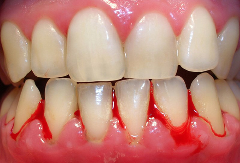 Nếu răng của bạn xuất hiện từ 1 đến 6 triệu chứng sau đây thì bạn cần đi kiểm tra răng càng sớm càng tốt - Ảnh 3.