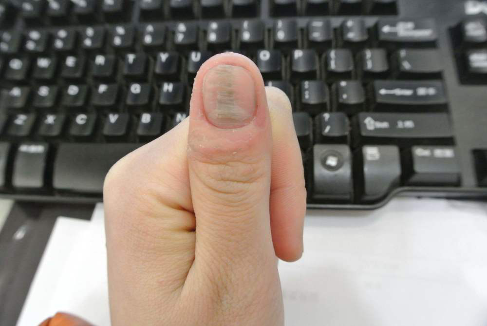 3 biểu hiện ở ngón tay cho thấy bạn đang bị xơ gan - Ảnh 1.