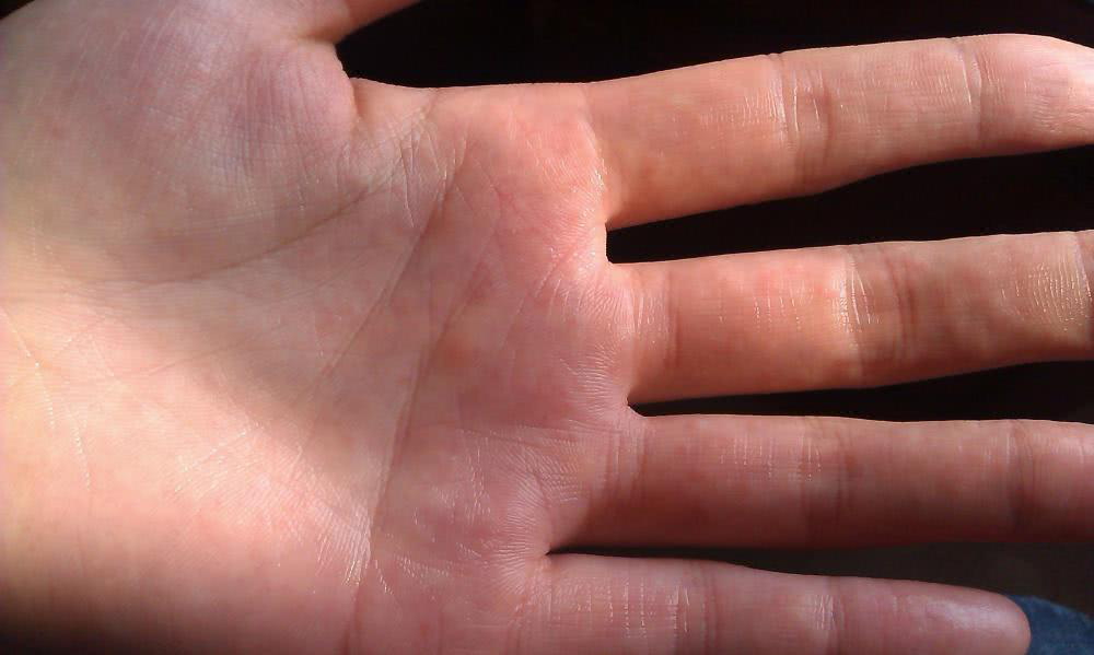 3 biểu hiện ở ngón tay cho thấy bạn đang bị xơ gan - Ảnh 2.