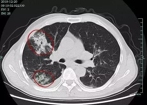 Dọn nhà đón Tết, người đàn ông Trung Quốc nhiễm nấm aspergillus vì ngôi nhà có quá nhiều bụi - Ảnh 2.