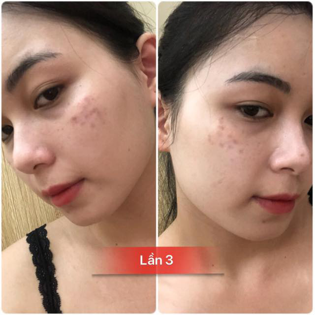 Review tường tận hành trình trị nám Hori bằng laser: Tưởng không xi nhê mà hiệu quả bất ngờ - Ảnh 5.