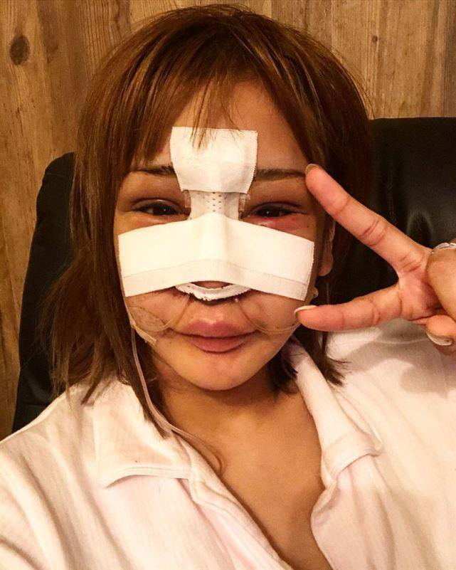 Bị chế giễu xấu như khỉ đột, c&ocirc; g&aacute;i cắn răng chịu đựng hơn 100 ca phẫu thuật trong 10 năm để trở th&agrave;nh tiếp vi&ecirc;n nổi tiếng nhất Nhật Bản - Ảnh 2.