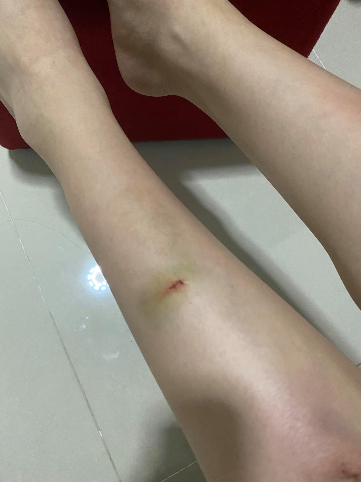 Thiều Bảo Trâm đăng ảnh tay chân bầm tím và chằng chịt vết thương, nguyên nhân được khổ chủ hé lộ luôn! - Ảnh 3.
