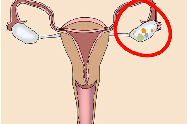 Con gái nên cẩn thận với 4 loại bệnh phụ khoa rất dễ phát triển thành ung thư, nhất là cái số 3 - Ảnh 3.