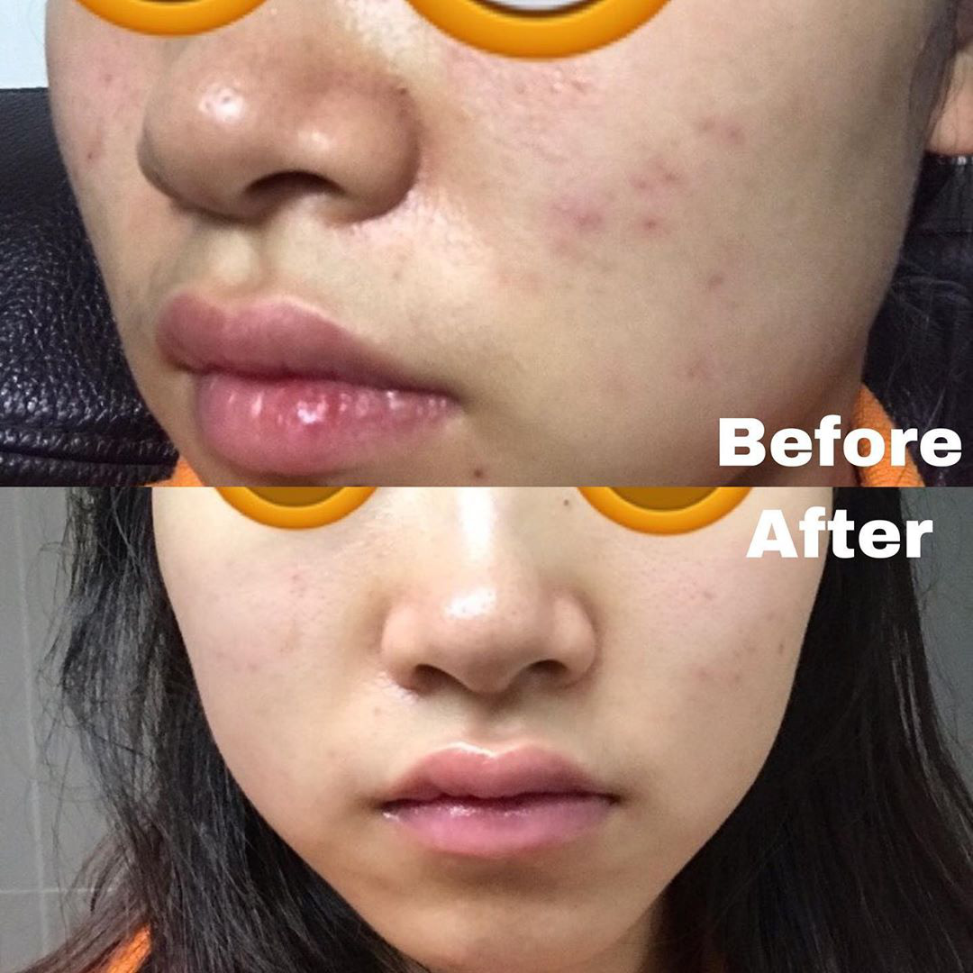 Biết 5 chiêu nặn mụn đúng cách, da sẽ nhanh lành, vết thâm cũng không có cửa xuất hiện - Ảnh 1. Biết 5 chiêu nặn mụn đúng cách, da sẽ nhanh lành, vết thâm cũng không có cửa xuất hiện - Ảnh 1.