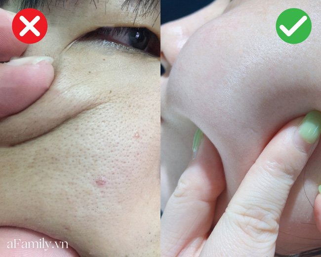 Ấn vào trán và má để kiểm tra xem da có đang bị quá tải khi sử dụng acid toner và loại bạn nên sắm - Ảnh 3. Ấn vào trán và má để kiểm tra xem da có đang bị quá tải khi sử dụng acid toner và loại bạn nên sắm - Ảnh 3.
