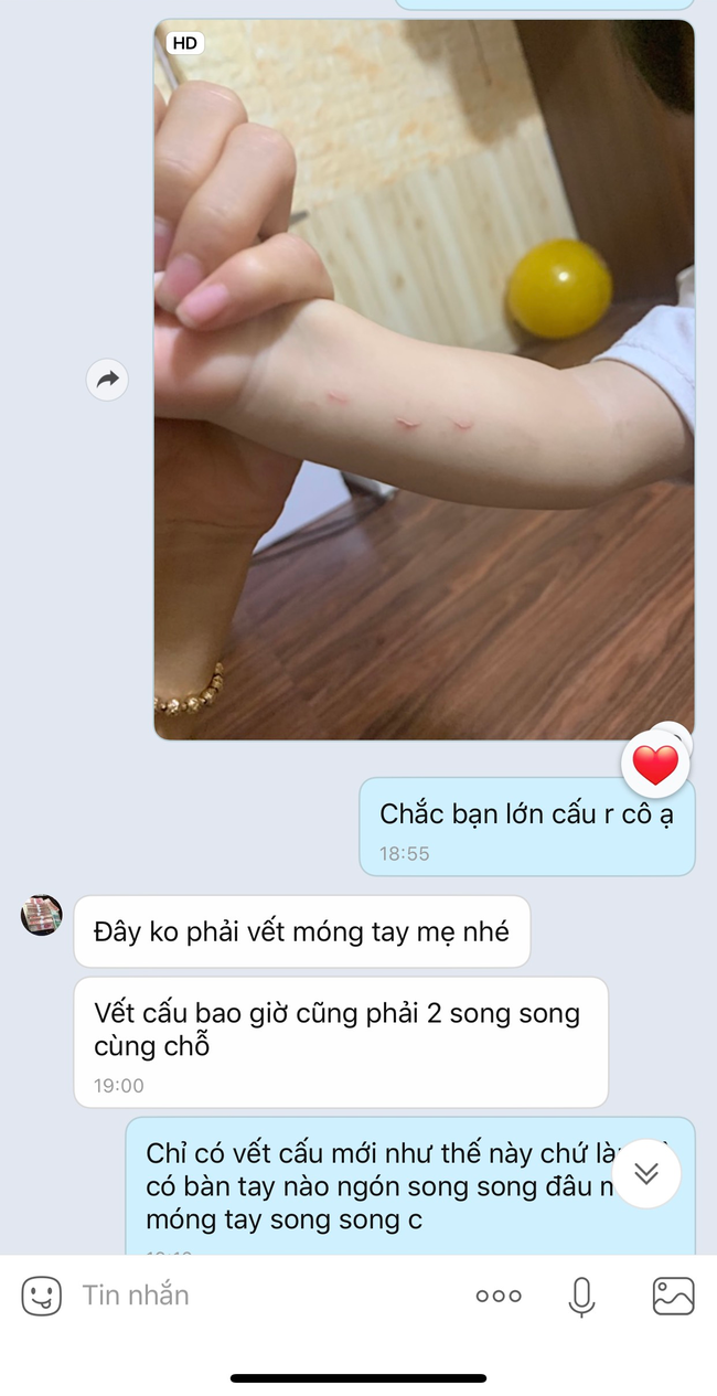 Bé mẫu giáo đi học về tay xuất hiện đầy vết bấm móng tay, nhà trường có bài giải thích khiến mẹ bức xúc vì sai sự thật? - Ảnh 2.