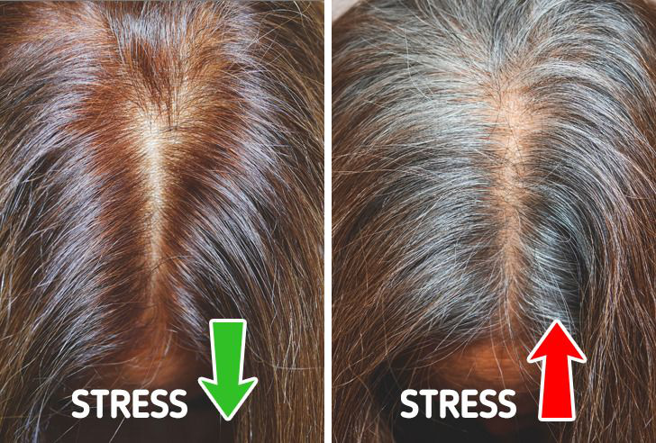 Không muốn tóc bạc sớm từ năm 20 tuổi, bạn nên chú ý tới 6 vấn đề là nguyên nhân điển hình gây ra tình trạng này - Ảnh 4.