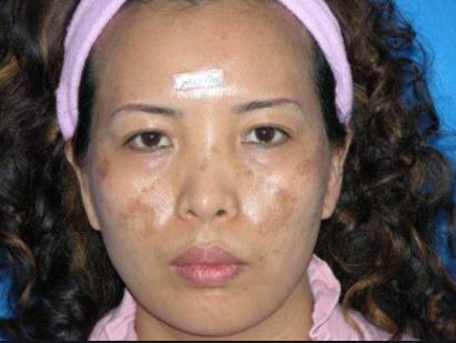 Lạm dụng quá nhiều vitamin C với mong muốn hồi xuân, người phụ nữ Trung Quốc thấy mặt nổi đầy nám, tàn nhang - Ảnh 2.