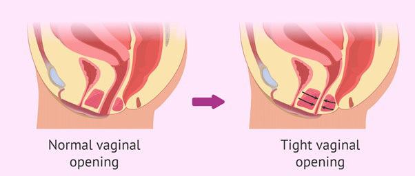 Kích thước “cô bé” quá hẹp có ảnh hưởng đến cuộc yêu hay không? - Ảnh 5.