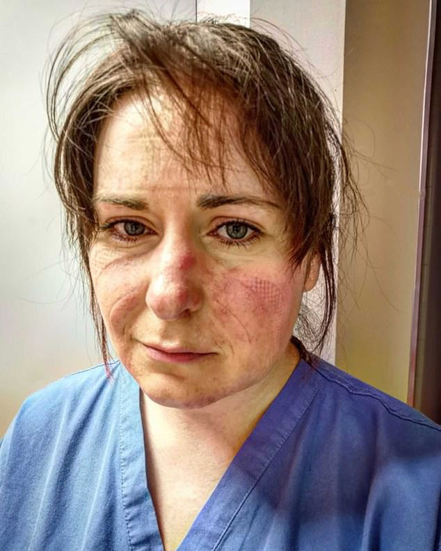 Nữ y tá xinh đẹp chia sẻ hình ảnh gương mặt biến dạng, đã đi qua địa ngục sau 65 tiếng làm việc và lời khẩn cầu dành cho tất cả mọi người - Ảnh 2.