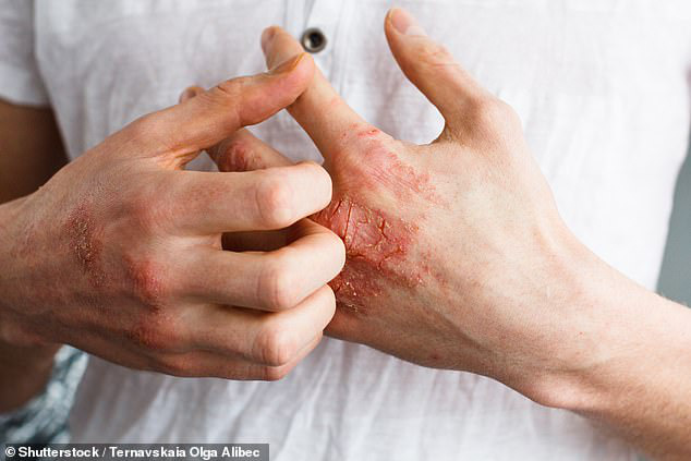 5 đặc điểm lạ xuất hiện trên bàn tay có thể là tín hiệu cảnh báo nguy cơ mắc bệnh xơ gan - Ảnh 3.