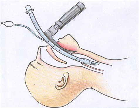 Bệnh nhân nhiễm Covid-19 phải nghiêm trọng thế nào mới phải sử dụng đến máy trợ thở? - Ảnh 5.