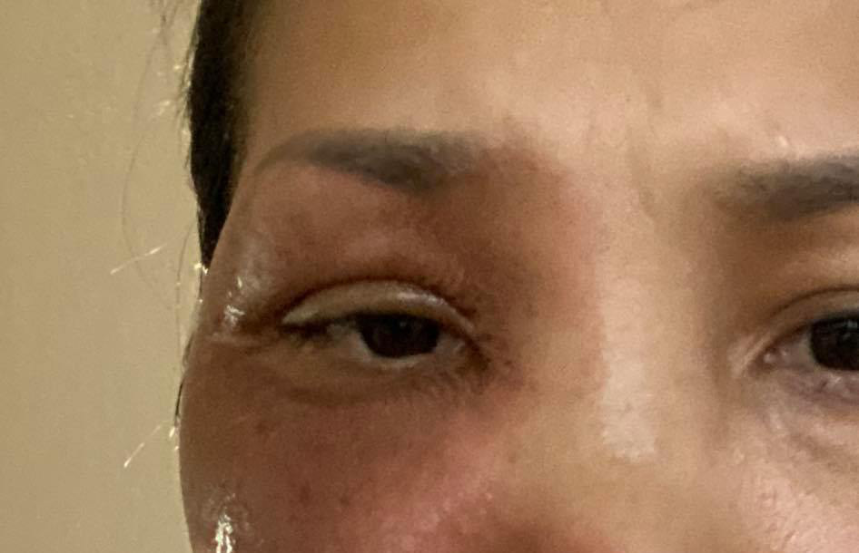 Ca sĩ Hồng Ngọc h&eacute; lộ ảnh cận vết bỏng nặng tr&ecirc;n mặt, d&agrave;n nghệ sĩ Vbiz chạnh l&ograve;ng rơi nước mắt - Ảnh 2.