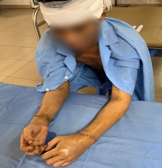 8 giờ, 30 y bác sỹ vừa phẫu thuật vết thương sọ não, vừa nối đồng thời 2 bàn tay đứt rời - Ảnh 1.