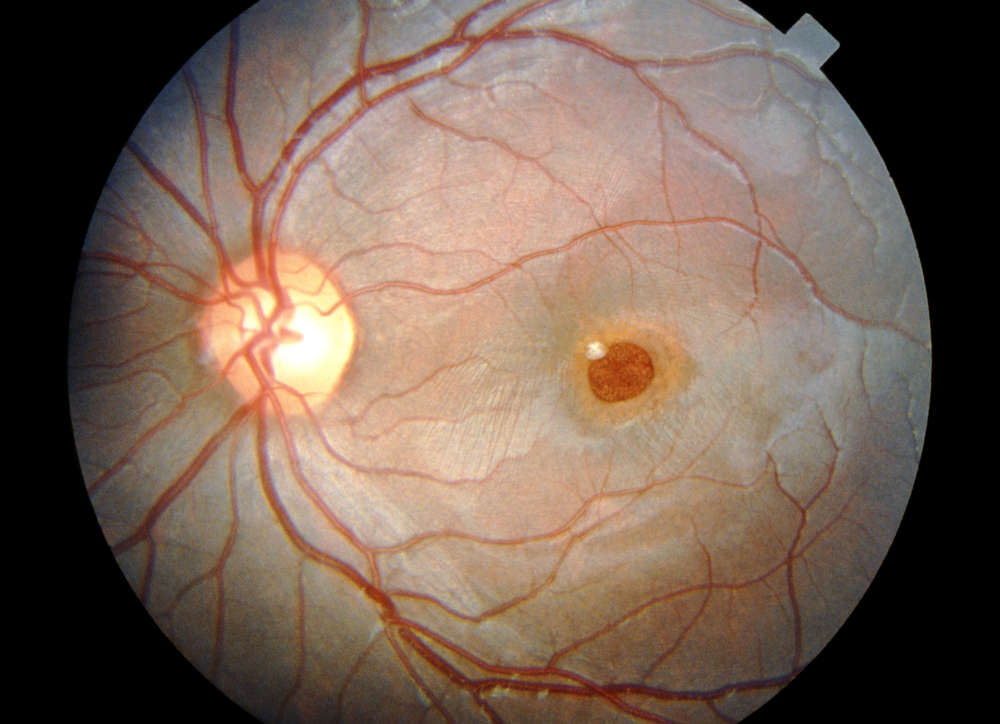 Без видимых патологий. Офтальмоскопия глазного дна. Офтальмоскопия сетчатки. Эпиретинальный фиброз офтальмоскопия.