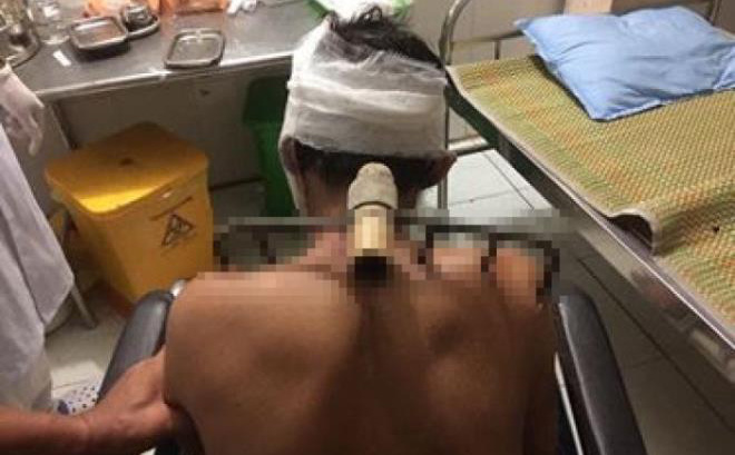 Người đ&agrave;n &ocirc;ng nhập viện trong t&igrave;nh trạng c&agrave;o vẫn d&iacute;nh tr&ecirc;n người do bị con trai bổ tr&uacute;ng - Ảnh 1.