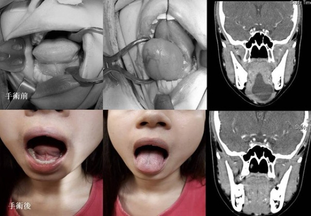 Cô gái nói chuyện không rõ, dưới lưỡi sưng phồng và có màu xanh giống như bụng nhái, bác sĩ kinh ngạc khi phát hiện khối u 6cm - Ảnh 2.