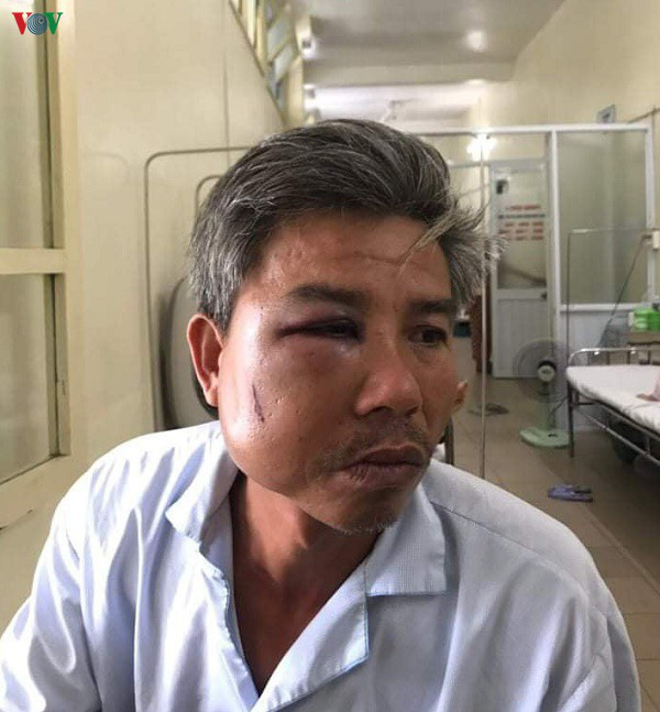 Khởi tố chủ qu&aacute;n c&agrave; ph&ecirc; đ&aacute;nh nh&acirc;n vi&ecirc;n c&acirc;y xanh nhập viện - Ảnh 2.