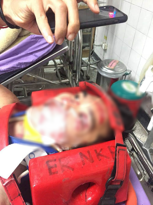 Chấn thương kinh hoàng của VĐV xe đạp Thái Lan: Mặt biến dạng, cột sống gãy, nặng đến nỗi không thể chuyển viện để điều trị - Ảnh 2.
