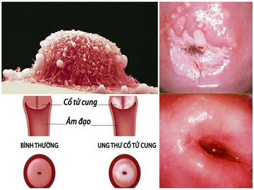 Cả nhà sốc vì nữ sinh 17 tuổi đã ung thư cổ tử cung: BS mách 1 việc cần làm để phòng bệnh hiệu quả - Ảnh 2.