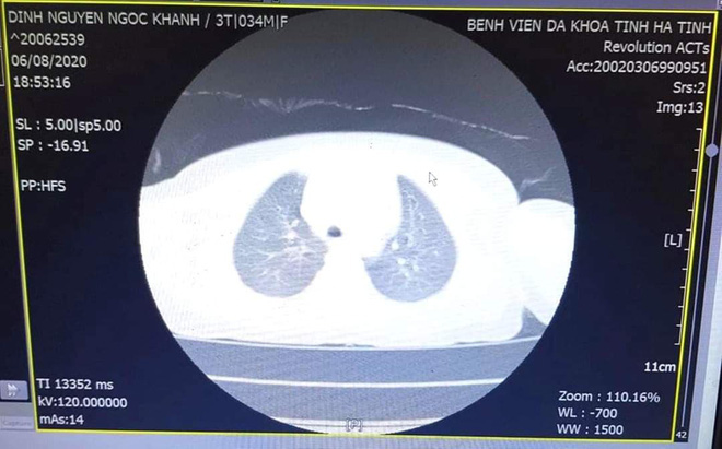 Bé 3 tuổi ho, khó thở không ngừng vì nút bấm điều khiển nằm trong khí quản - Ảnh 2.