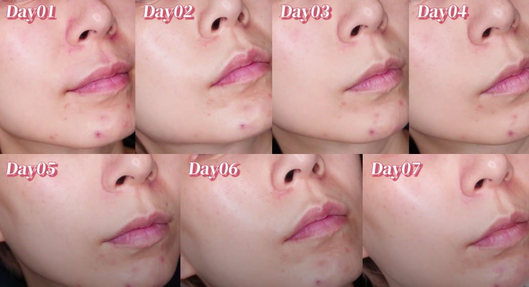 Beauty blogger xứ Đài trực tiếp check khả năng trị nám, trẻ hóa da của serum Kiehls: Sau 7 ngày vết thâm to mờ dần, vết nhỏ lặn mất tăm - Ảnh 6.