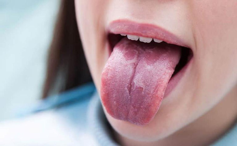 Lưỡi có thể tiết lộ tình trạng sức khỏe của bạn đang gặp vấn đề gì: quan sát 3 đặc điểm sau ở lưỡi là sẽ thấy rõ - Ảnh 3.