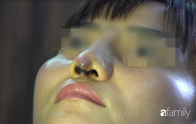 Người phụ nữ bị đứt lìa trụ mũi, chảy dịch và máu sau 12 ngày đi nâng mũi chui - Ảnh 1.