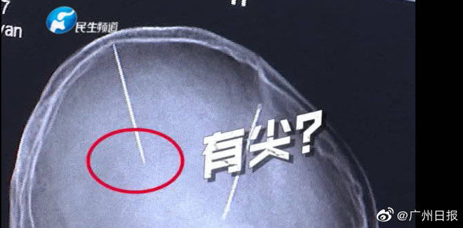 Sau tai nạn ô tô người phụ nữ Trung Quốc bất ngờ phát hiện có hai cây kim được găm vào trong não mà không hề có ký ức gì - Ảnh 2.